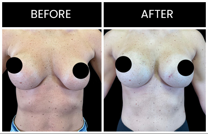 Atlanta Breast Implant Replacement Results